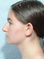Otoplasty