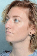 Rhinoplasty