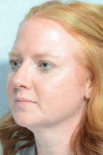 Rhinoplasty