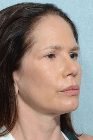 Rhinoplasty