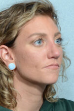 Rhinoplasty
