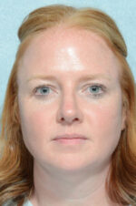 Rhinoplasty