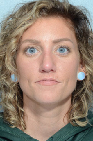 Rhinoplasty