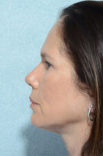Rhinoplasty