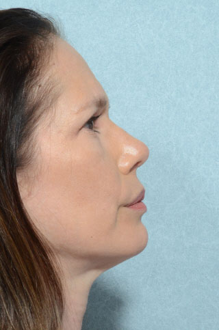 Rhinoplasty