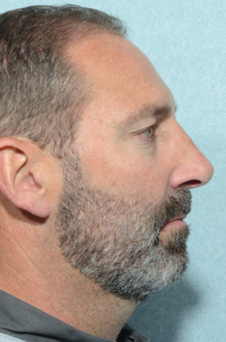 Rhinoplasty