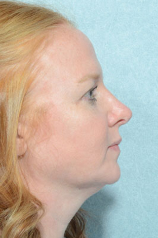 Rhinoplasty