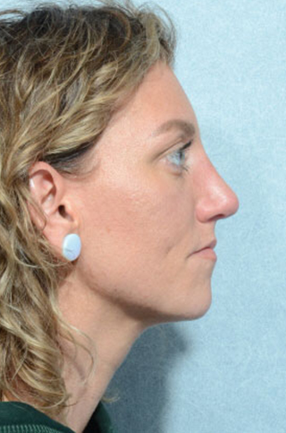 Rhinoplasty