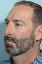 Rhinoplasty