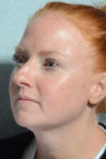 Rhinoplasty