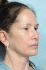 Rhinoplasty