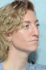 Rhinoplasty