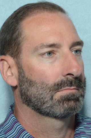 Rhinoplasty