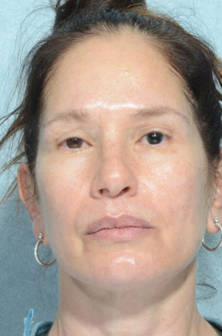 Rhinoplasty