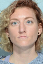 Rhinoplasty