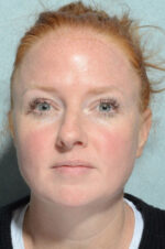 Rhinoplasty
