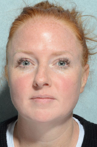 Rhinoplasty