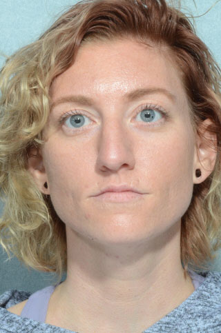 Rhinoplasty