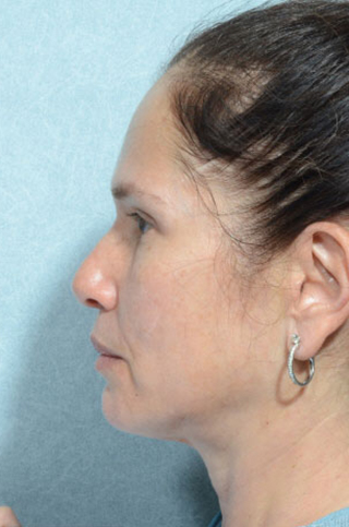 Rhinoplasty