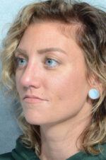Rhinoplasty