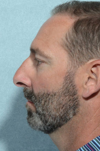 Rhinoplasty