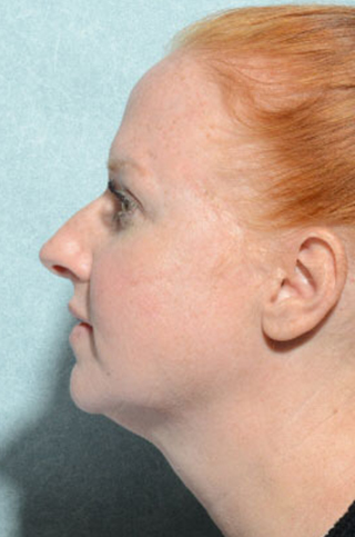 Rhinoplasty