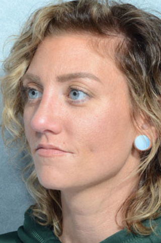 Rhinoplasty