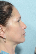 Rhinoplasty