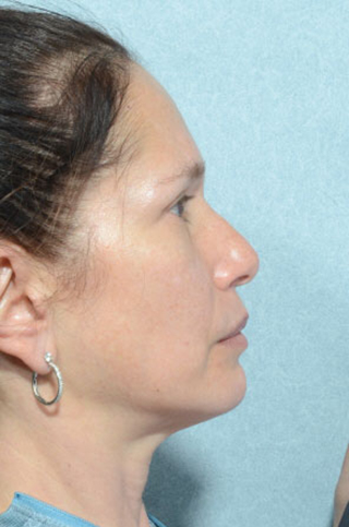 Rhinoplasty