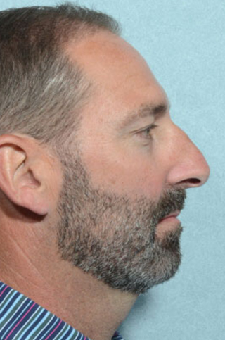 Rhinoplasty
