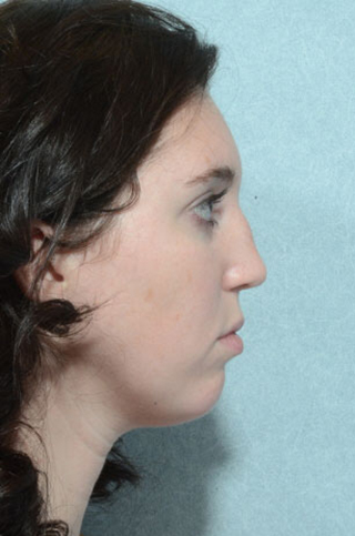 Rhinoplasty