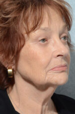 Facelift