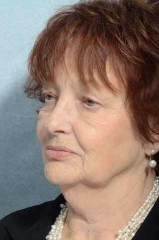 Facelift