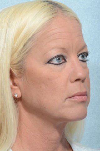Facelift