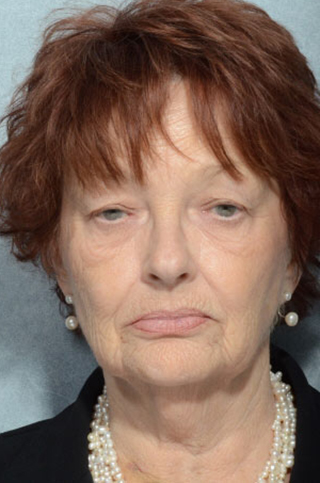Facelift