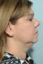 Facelift