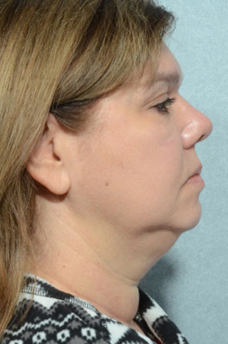 Facelift