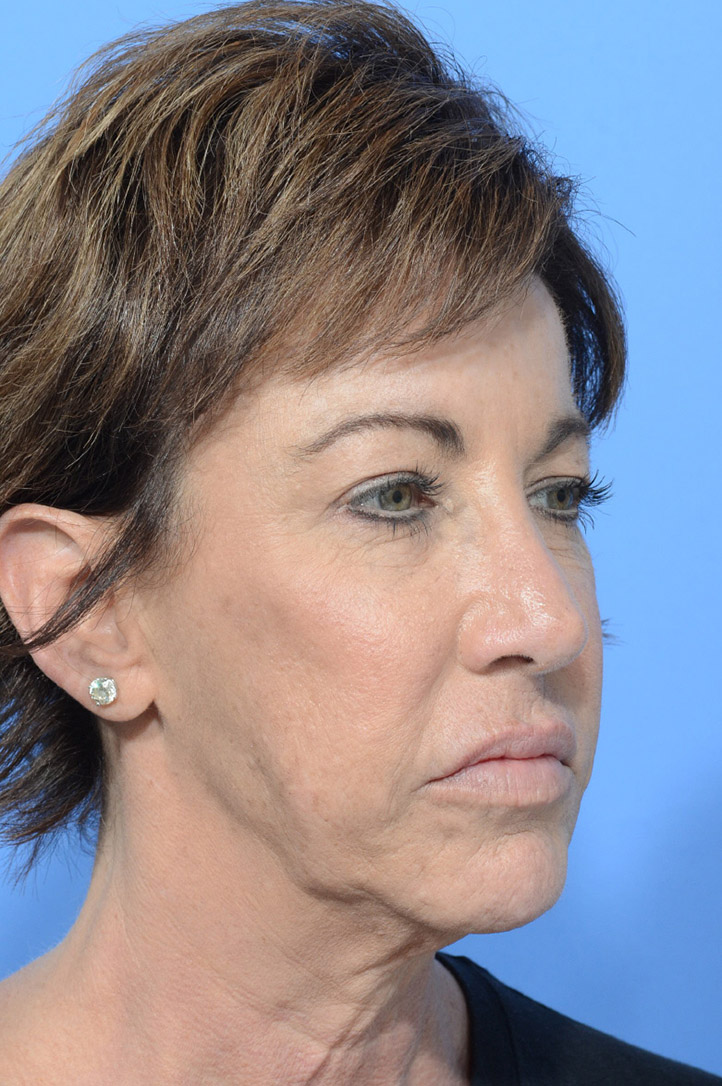 Facelift