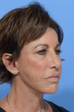 Facelift