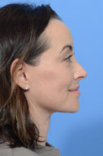 Facelift