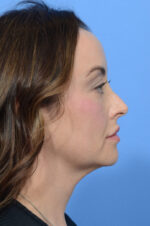 Facelift