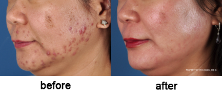 ZO Skin Health Before and After
