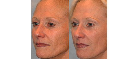 Pearl Fractional Laser Before and After Results