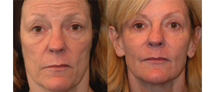Botox  Before and After Results