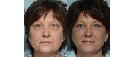 Eyelid Surgery Before & After in Indianapolis by Dr. Chegar
