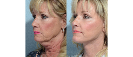 Facelift Before & After in Indianapolis by Dr. Burke Chegar