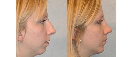Rhinoplasty Before Photo in Indianapolis by Dr. Chegar