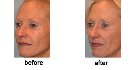 Pearl Fractional Laser Treatment Before & After